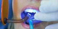 Sbiancamento dentale con laser Tolentino